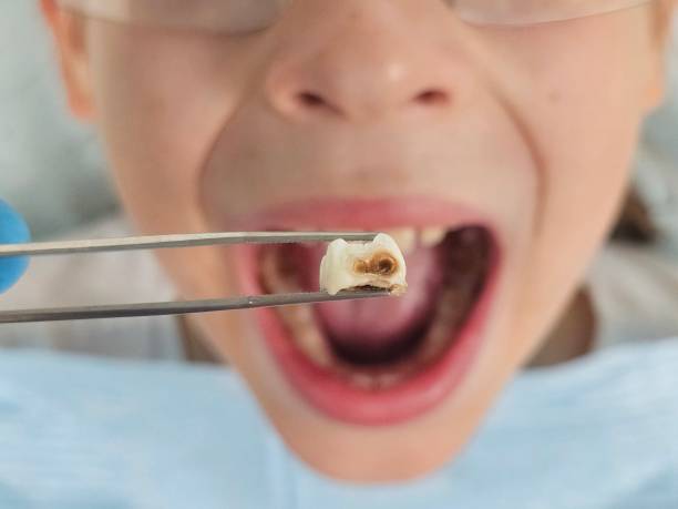 Best Broken Tooth Emergency  in Cloverdale, IN